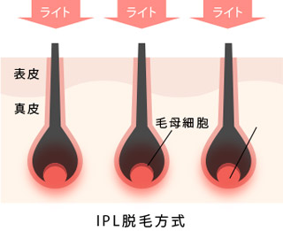 Rinrin リンリン は脱毛機メーカー直営 安くて効果あり